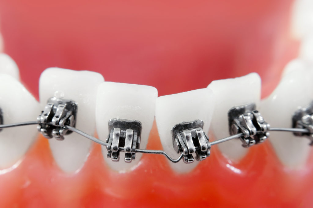 How do braces fix your teeth